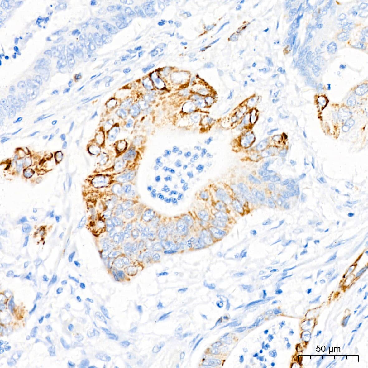 Immunohistochemistry: Monoamine Oxidase B Antibody (5M8A5) [NBP3-15411] - Immunohistochemistry analysis of Monoamine Oxidase B in paraffin-embedded human colon carcinoma tissue using Monoamine Oxidase B Rabbit mAb  at a dilution of 1:200 (40x lens).High pressure antigen retrieval was performed with 0.01 M citrate buffer (pH 6.0) prior to IHC staining.