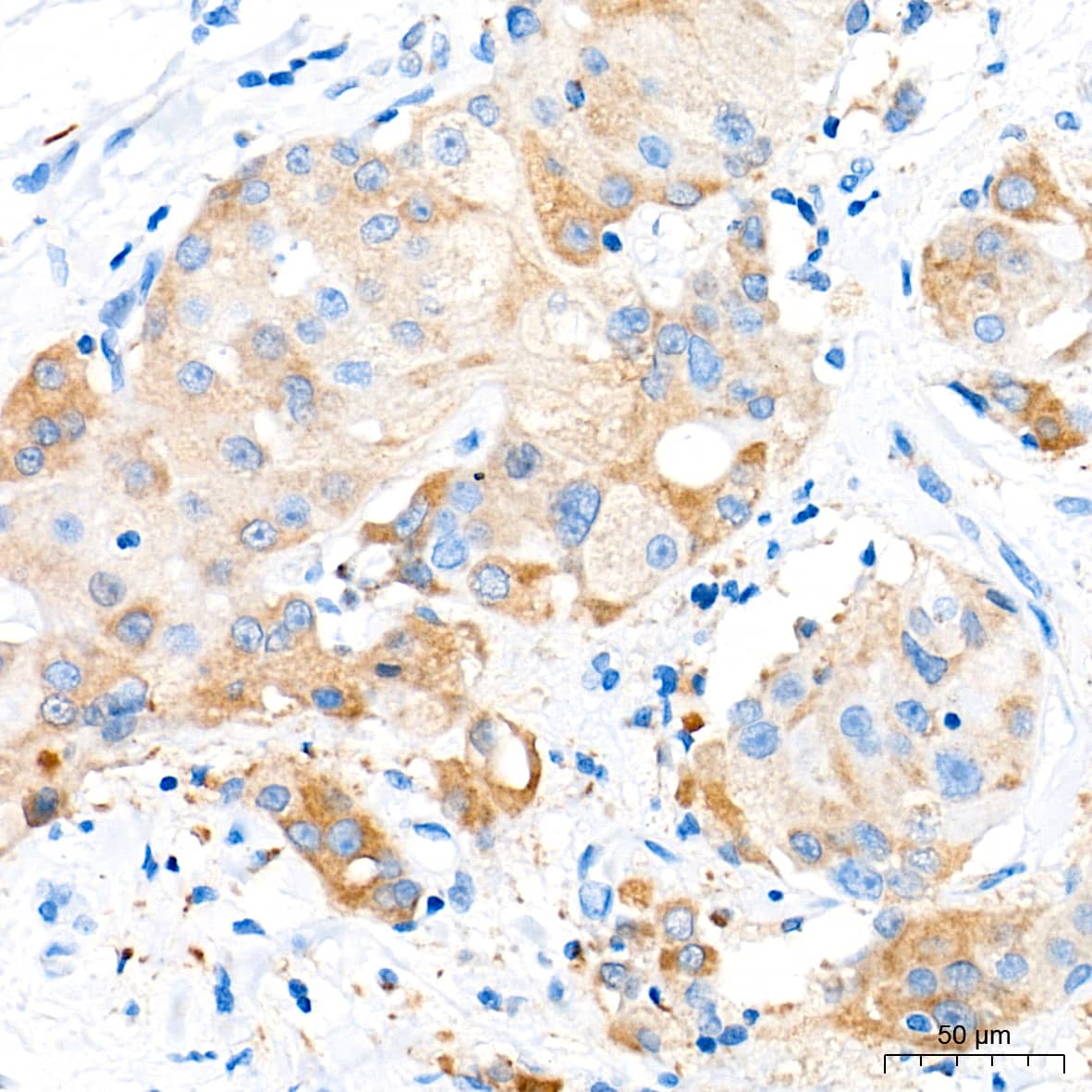 Immunohistochemistry: CBS Antibody (1R2E9) [CBS] - Immunohistochemistry analysis of paraffin-embedded Human breast cancer tissue using CBS Rabbit mAb  at a dilution of 1:100 (40x lens). High pressure antigen retrieval performed with 0.01M Tris-EDTA Buffer (pH 9.0) prior to IHC staining.