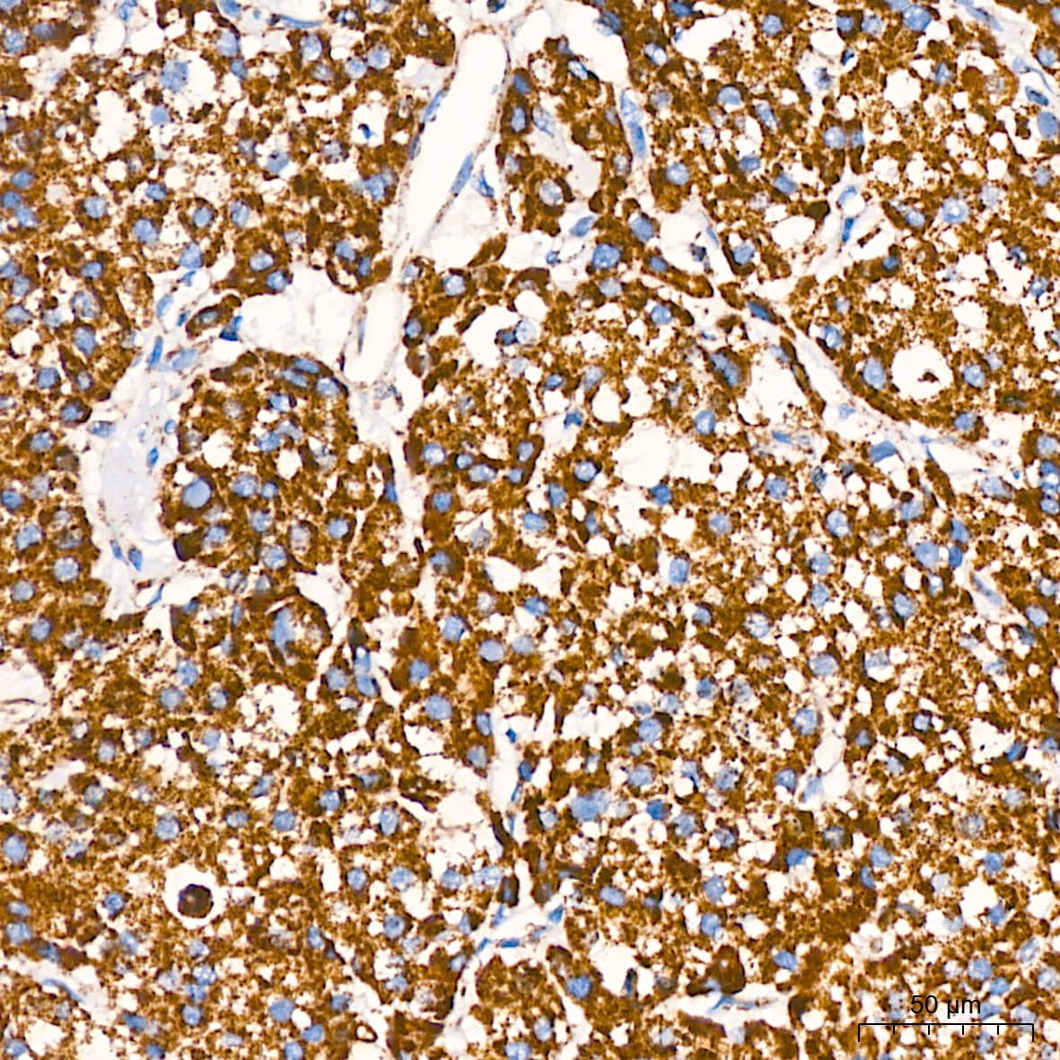 Immunohistochemistry: COX4 Antibody (3P8J2) [COX4] - Immunohistochemistry analysis of paraffin-embedded Human liver cancer using COX4 Rabbit mAb  at dilution of 1:200 (40x lens). High pressure antigen retrieval performed with 0.01M Citrate Bufferr (pH 6.0) prior to IHC staining.