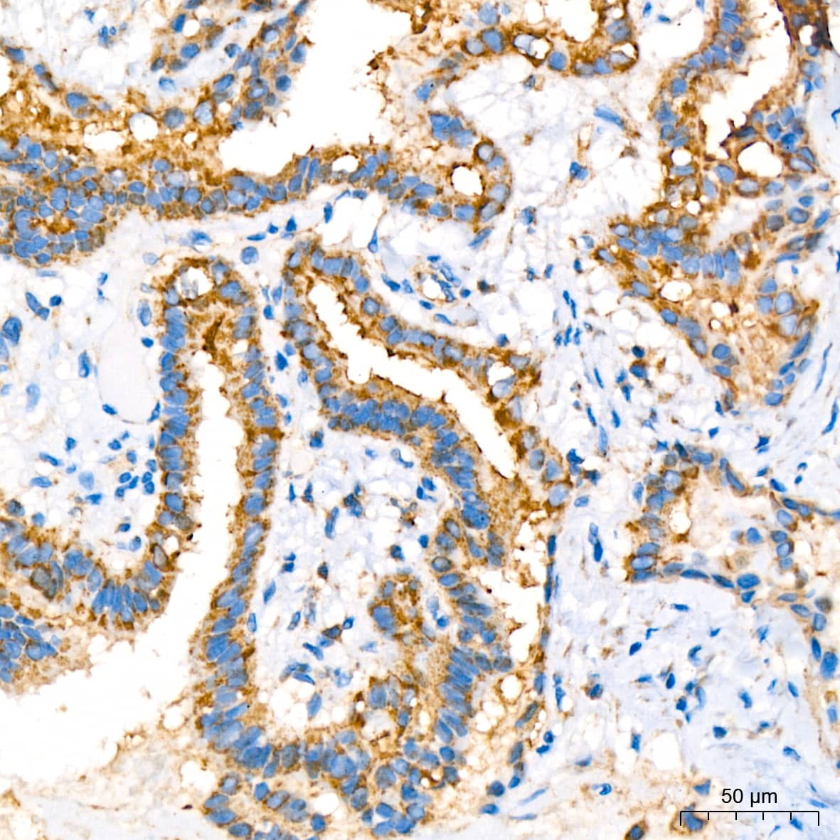 Immunohistochemistry: COX4 Antibody (3P8J2) [COX4] - Immunohistochemistry analysis of paraffin-embedded Human thyroid cancer using COX4 Rabbit mAb  at dilution of 1:200 (40x lens). High pressure antigen retrieval performed with 0.01M Citrate Bufferr (pH 6.0) prior to IHC staining.