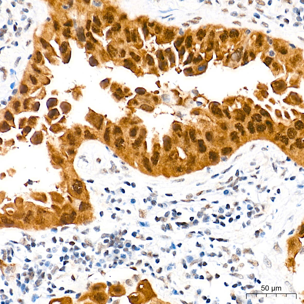 Immunohistochemistry: p16INK4a/CDKN2A Antibody (0D0C8) [p16INK4a/CDKN2A] - Immunohistochemistry analysis of paraffin-embedded Human lung squamous carcinoma tissue tissue using [KO Validated] p16INK4a/CDKN2A Rabbit mAb  at a dilution of 1:500 (40x lens). High pressure antigen retrieval performed with 0.01M Tris-EDTA Buffer(pH 9.0) prior to IHC staining.