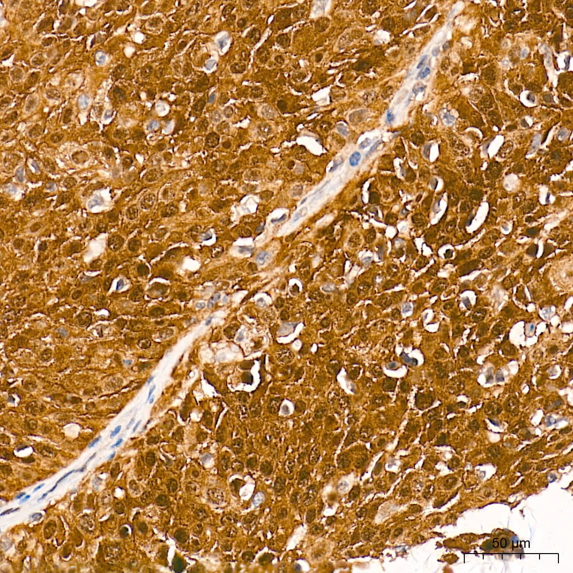 Immunohistochemistry: p16INK4a/CDKN2A Antibody (0D0C8) [p16INK4a/CDKN2A] - Immunohistochemistry analysis of paraffin-embedded Human cervix cancer tissue using [KO Validated] p16INK4a/CDKN2A Rabbit mAb  at a dilution of 1:500 (40x lens). High pressure antigen retrieval performed with 0.01M Tris-EDTA Buffer(pH 9.0) prior to IHC staining.