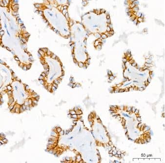 Immunohistochemistry-Paraffin: Sodium Potassium ATPase Alpha 1 Antibody (3L6F0) [NBP3-15427] -  Analysis of Na+/K+-ATPase in paraffin-embedded human thyroid cancer using Na+/K+-ATPase Rabbit mAb at dilution of 1:400 (40x lens).Perform high pressure antigen retrieval with 10 mM citrate buffer pH 6.0 before commencing with IHC staining protocol.