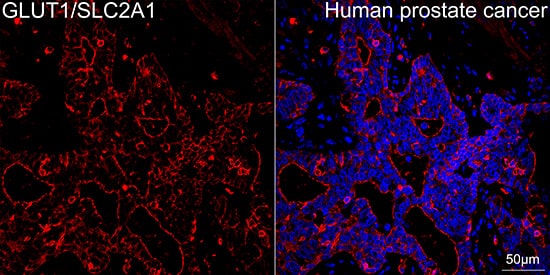 Immunocytochemistry/ Immunofluorescence: Glut1 Antibody (10O1I5) [Glut1] - Confocal imaging of paraffin-embedded Human prostate cancer tissue using Glut1 Rabbit mAb  followed by a further incubation with Cy3 Goat Anti-Rabbit IgG (H+L)  . DAPI was used for nuclear staining (Blue). Objective: 40x. Perform high pressure antigen retrieval with 0.01 M citrate buffer (pH 6.0) prior to IF staining.