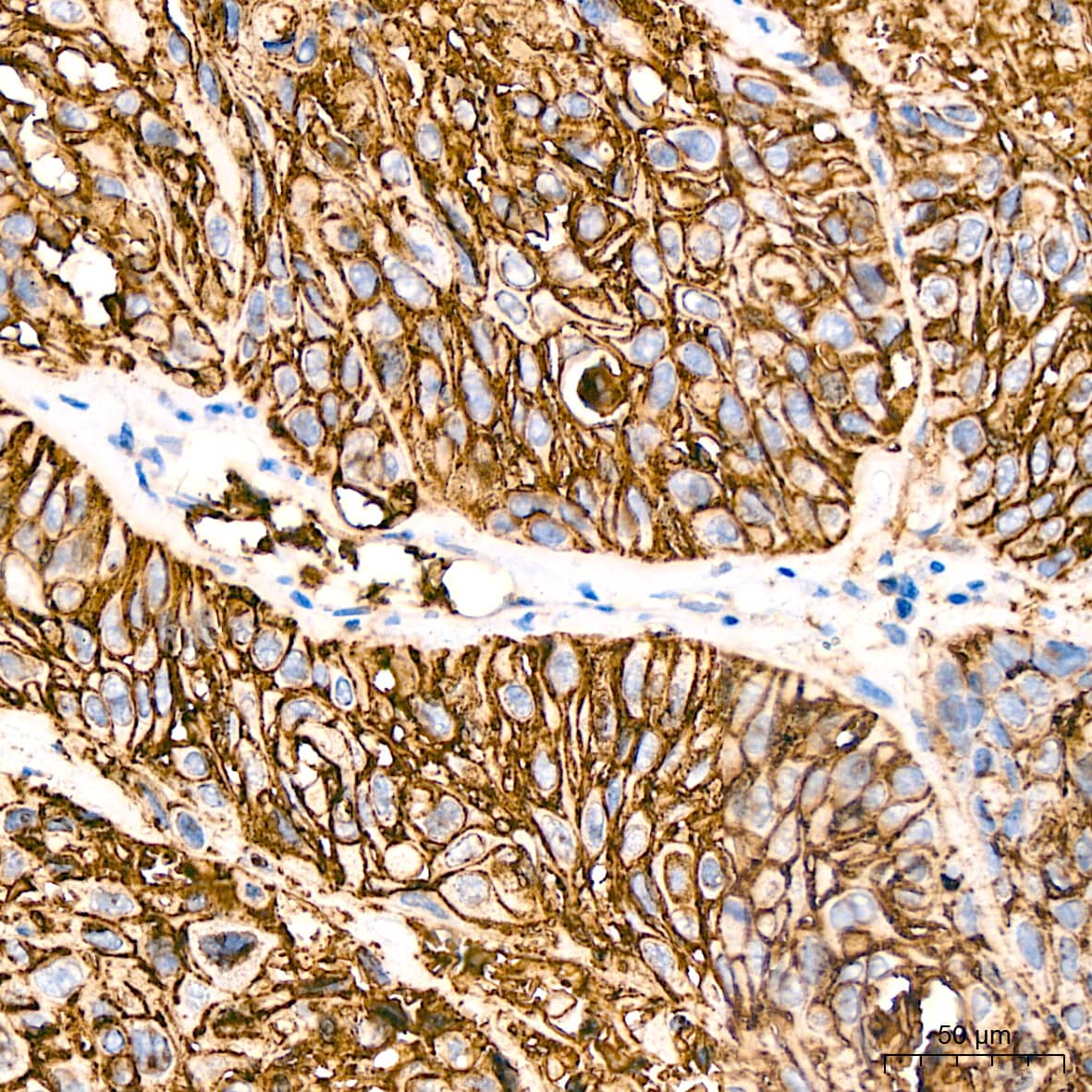 Immunohistochemistry: Glut1 Antibody (10O1I5) [Glut1] - Immunohistochemistry analysis of paraffin-embedded Human lung squamous carcinoma tissue using Glut1 Rabbit mAb  at a dilution of 1:800 (40x lens). High pressure antigen retrieval performed with 0.01M Tris-EDTA Buffer (pH 9.0) prior to IHC staining.