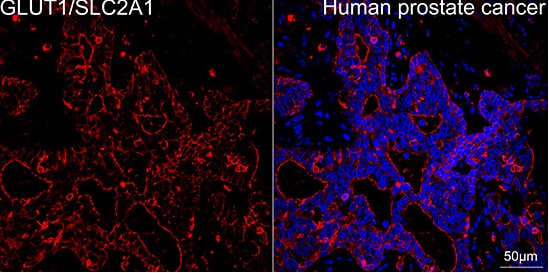 Human prostate cancer tissue using GLUT1/SLC2A1 Rabbit mAb (dilution 1:200) followed by a further incubation with Cy3 Goat Anti-Rabbit IgG (H+L) (dilution 1:500) (Red). DAPI was used for nuclear staining (Blue). Objective: 40x. Perform high pressure antigen retrieval with 0.01 M citrate buffer (pH 6.0) prior to IF staining.