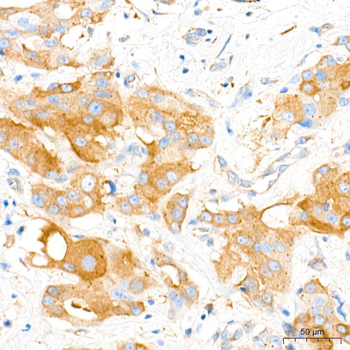 Immunohistochemistry: Aromatase Antibody (5C5N7) [Aromatase] - Immunohistochemistry analysis of paraffin-embedded Human breast cancer tissue using Aromatase Rabbit mAb  at a dilution of 1:4000 (40x lens). High pressure antigen retrieval performed with 0.01M Tris-EDTA Buffer(pH 9.0) prior to IHC staining.