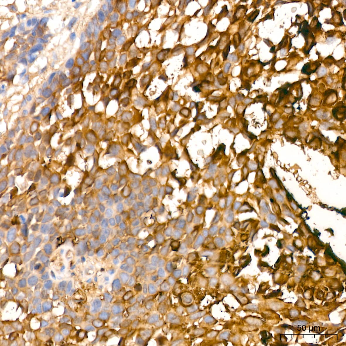 Immunohistochemistry: Involucrin Antibody (8H7B3) [Involucrin] - Immunohistochemistry analysis of paraffin-embedded Human cervix cancer tissue using Involucrin Rabbit mAb  at a dilution of 1:200 (40x lens). High pressure antigen retrieval performed with 0.01M Citrate Bufferr (pH 6.0) prior to IHC staining.