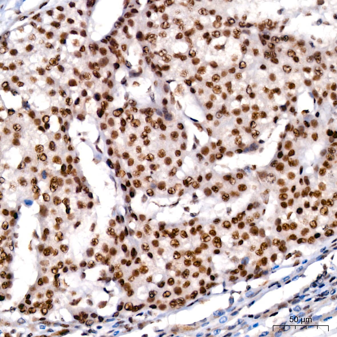 Immunohistochemistry: KLF4 Antibody (7B7U1) [KLF4] - Immunohistochemistry analysis of paraffin-embedded Human liver cancer using KLF4 Rabbit mAb  at dilution of 1:200 (40x lens). High pressure antigen retrieval performed with 0.01M Citrate Bufferr (pH 6.0) prior to IHC staining.