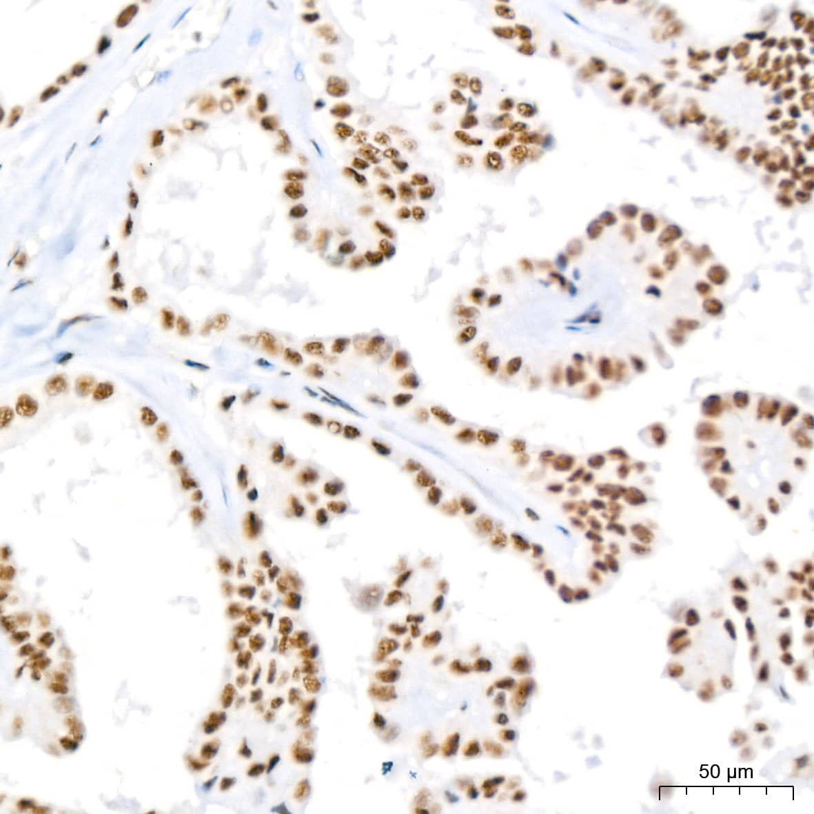 Immunohistochemistry: PABPN1 Antibody (7V4X8) [PABPN1] - Immunohistochemistry analysis of paraffin-embedded Human thyroid cancer tissue using PABPN1 Rabbit mAb  at a dilution of 1:200 (40x lens). High pressure antigen retrieval performed with 0.01M Citrate Bufferr (pH 6.0) prior to IHC staining.