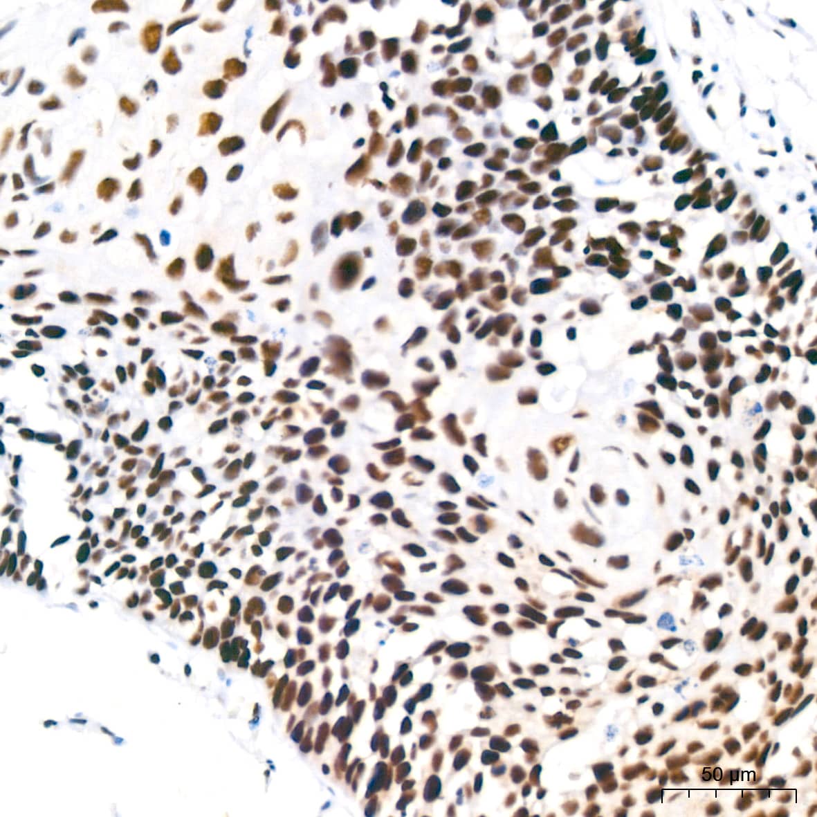 Immunohistochemistry: PABPN1 Antibody (7V4X8) [PABPN1] - Immunohistochemistry analysis of paraffin-embedded Human cervix cancer tissue using PABPN1 Rabbit mAb  at a dilution of 1:200 (40x lens). High pressure antigen retrieval performed with 0.01M Citrate Bufferr (pH 6.0) prior to IHC staining.