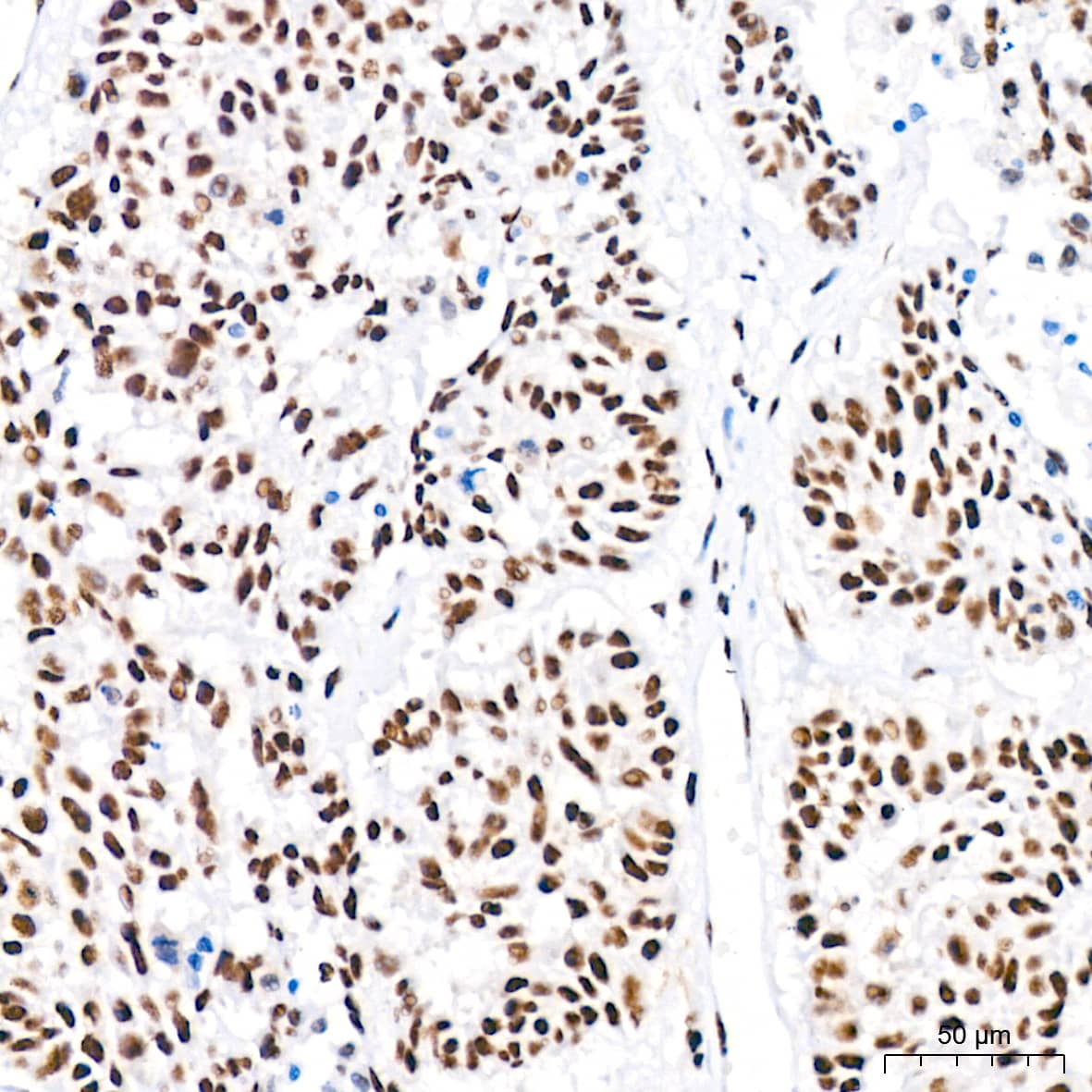 Immunohistochemistry: PABPN1 Antibody (7V4X8) [PABPN1] - Immunohistochemistry analysis of paraffin-embedded Human lung squamous carcinoma tissue tissue using PABPN1 Rabbit mAb  at a dilution of 1:200 (40x lens). High pressure antigen retrieval performed with 0.01M Citrate Bufferr (pH 6.0) prior to IHC staining.