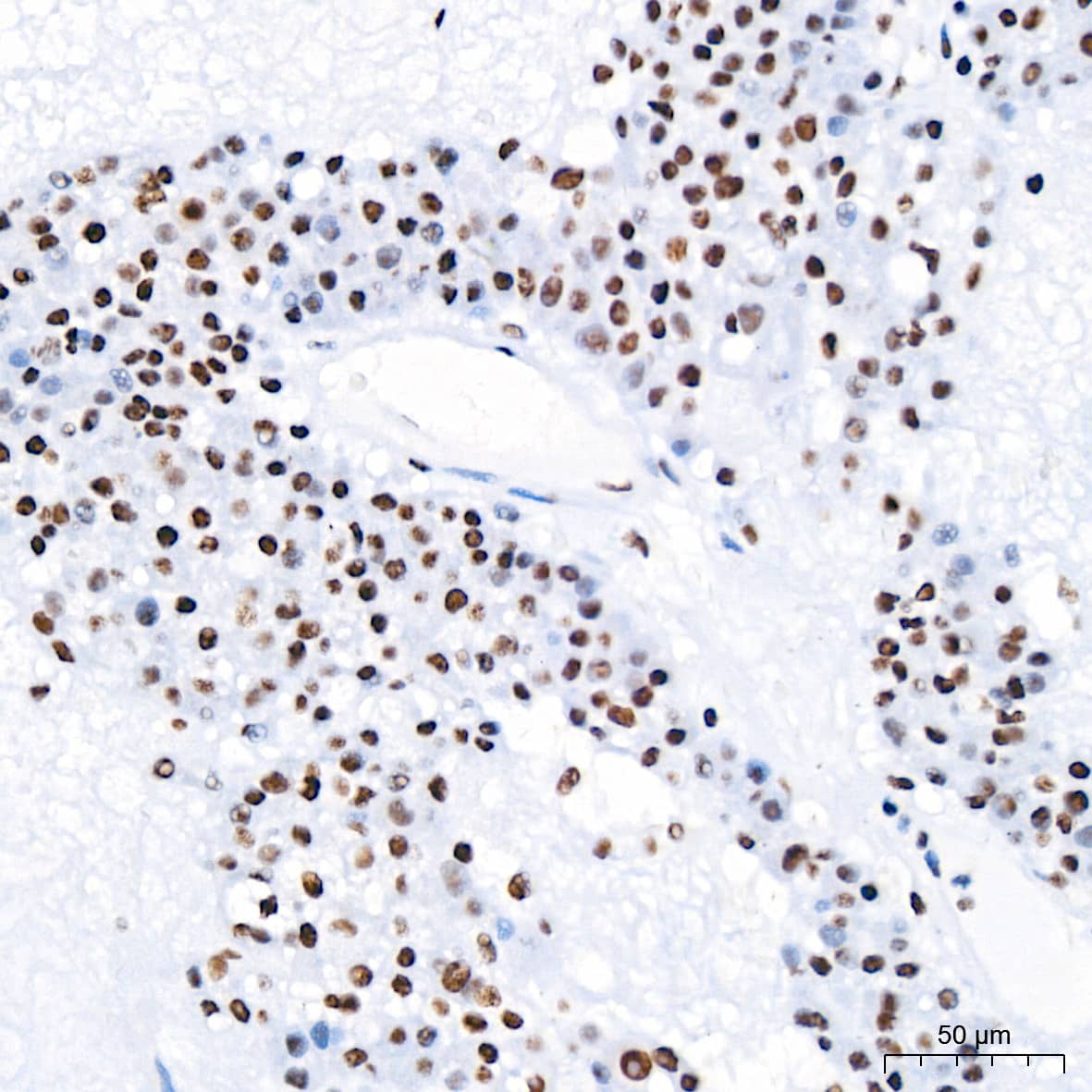 Immunohistochemistry: PABPN1 Antibody (7V4X8) [PABPN1] - Immunohistochemistry analysis of paraffin-embedded Human liver cancer tissue using PABPN1 Rabbit mAb  at a dilution of 1:200 (40x lens). High pressure antigen retrieval performed with 0.01M Citrate Bufferr (pH 6.0) prior to IHC staining.