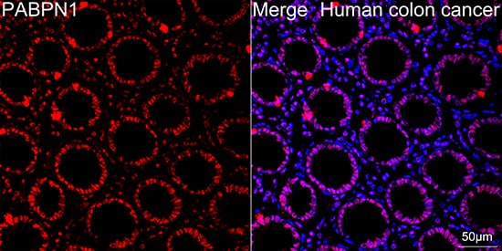 Immunocytochemistry/ Immunofluorescence: PABPN1 Antibody (7V4X8) [PABPN1] - Confocal imaging of paraffin-embedded Human colon cancer using PABPN1 Rabbit mAb  followed by a further incubation with Cy3 Goat Anti-Rabbit IgG (H+L)  . DAPI was used for nuclear staining (Blue). Objective: 40x. Perform high pressure antigen retrieval with 0.01 M citrate buffer (pH 6.0) prior to IF staining.