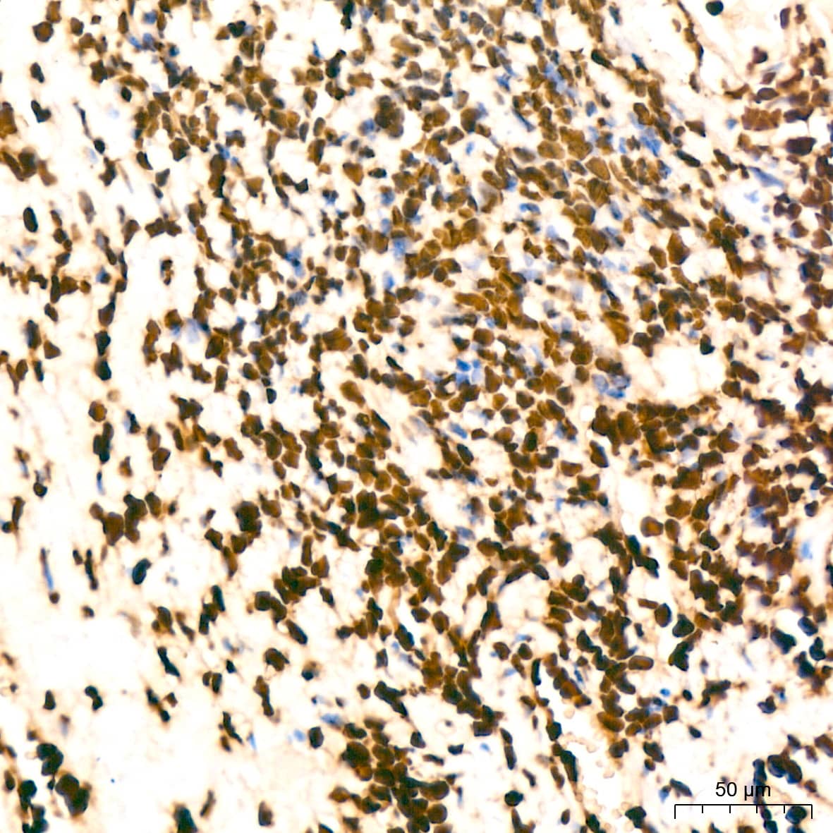 Immunohistochemistry: Histone H2B Antibody (3U2P5) [Histone H2B] - Immunohistochemistry analysis of paraffin-embedded Human cervix cancer tissue using Histone H2B Rabbit mAb  at a dilution of 1:200 (40x lens). High pressure antigen retrieval performed with 0.01M Tris-EDTA Buffer (pH 9.0) prior to IHC staining.