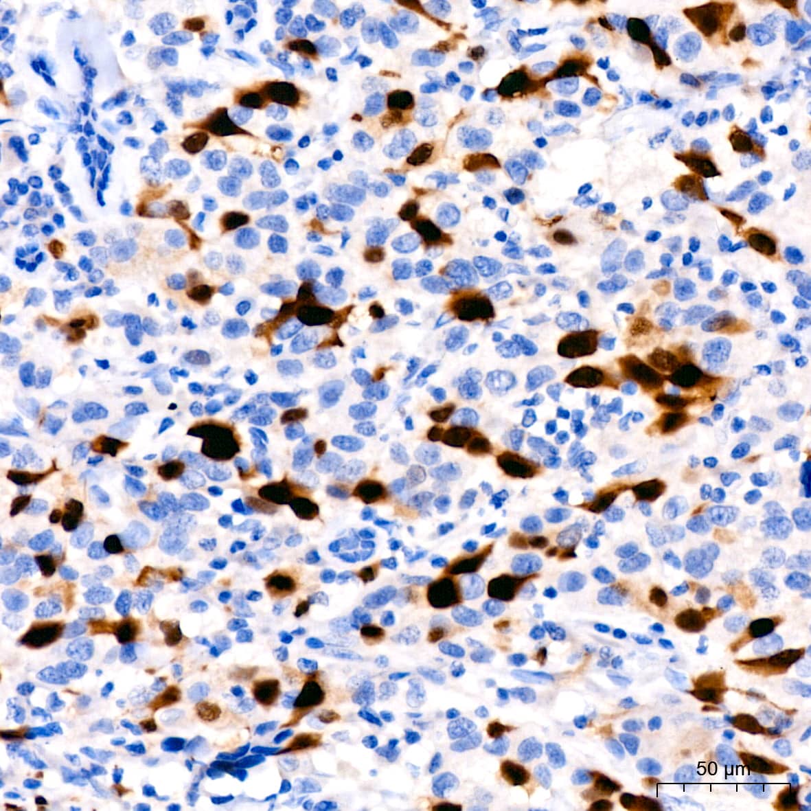 Immunohistochemistry: Cyclin A2 Antibody (3E9Z3) [Cyclin A2] - Immunohistochemistry analysis of paraffin-embedded Human breast cancer using Cyclin A2 Rabbit mAb  at dilution of 1:200 (40x lens). High pressure antigen retrieval performed with 0.01M Citrate Bufferr (pH 6.0) prior to IHC staining.