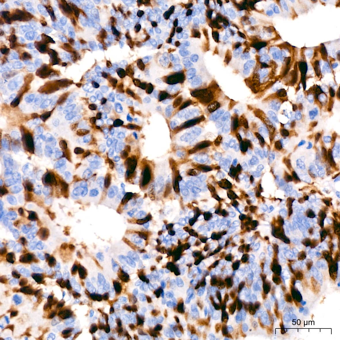 Immunohistochemistry: Cyclin A2 Antibody (3E9Z3) [Cyclin A2] - Immunohistochemistry analysis of paraffin-embedded Human colon carcinoma using Cyclin A2 Rabbit mAb  at dilution of 1:200 (40x lens). High pressure antigen retrieval performed with 0.01M Citrate Bufferr (pH 6.0) prior to IHC staining.