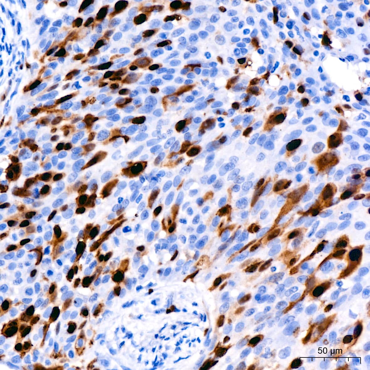 Immunohistochemistry: Cyclin A2 Antibody (3E9Z3) [Cyclin A2] - Immunohistochemistry analysis of paraffin-embedded Human cervical squamous cell carcinoma using Cyclin A2 Rabbit mAb  at dilution of 1:200 (40x lens). High pressure antigen retrieval performed with 0.01M Citrate Bufferr (pH 6.0) prior to IHC staining.