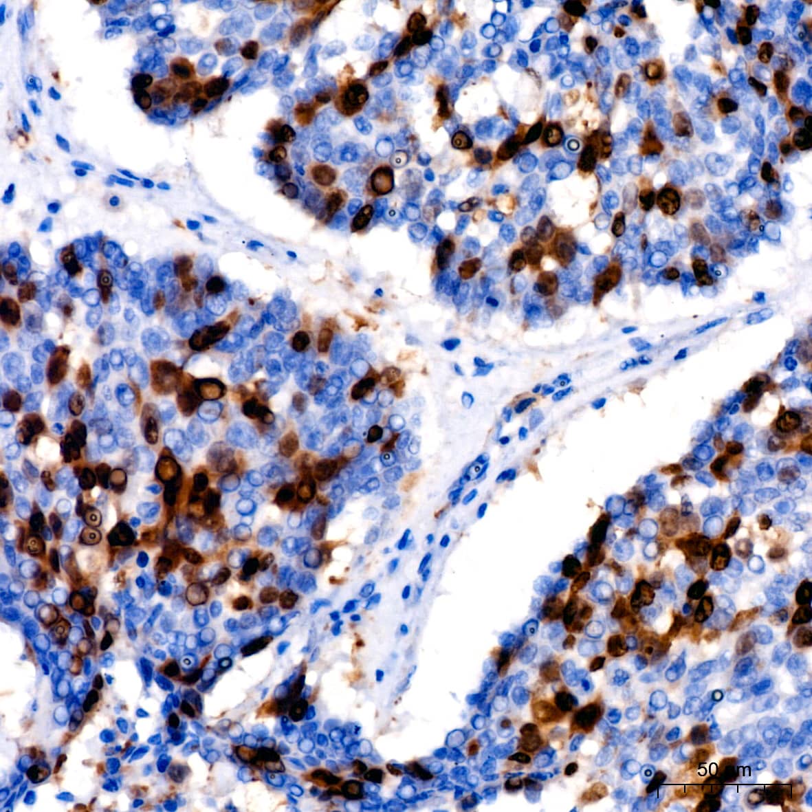 Immunohistochemistry: Cyclin A2 Antibody (3E9Z3) [Cyclin A2] - Immunohistochemistry analysis of paraffin-embedded Human lung cancer using Cyclin A2 Rabbit mAb  at dilution of 1:200 (40x lens). High pressure antigen retrieval performed with 0.01M Citrate Bufferr (pH 6.0) prior to IHC staining.