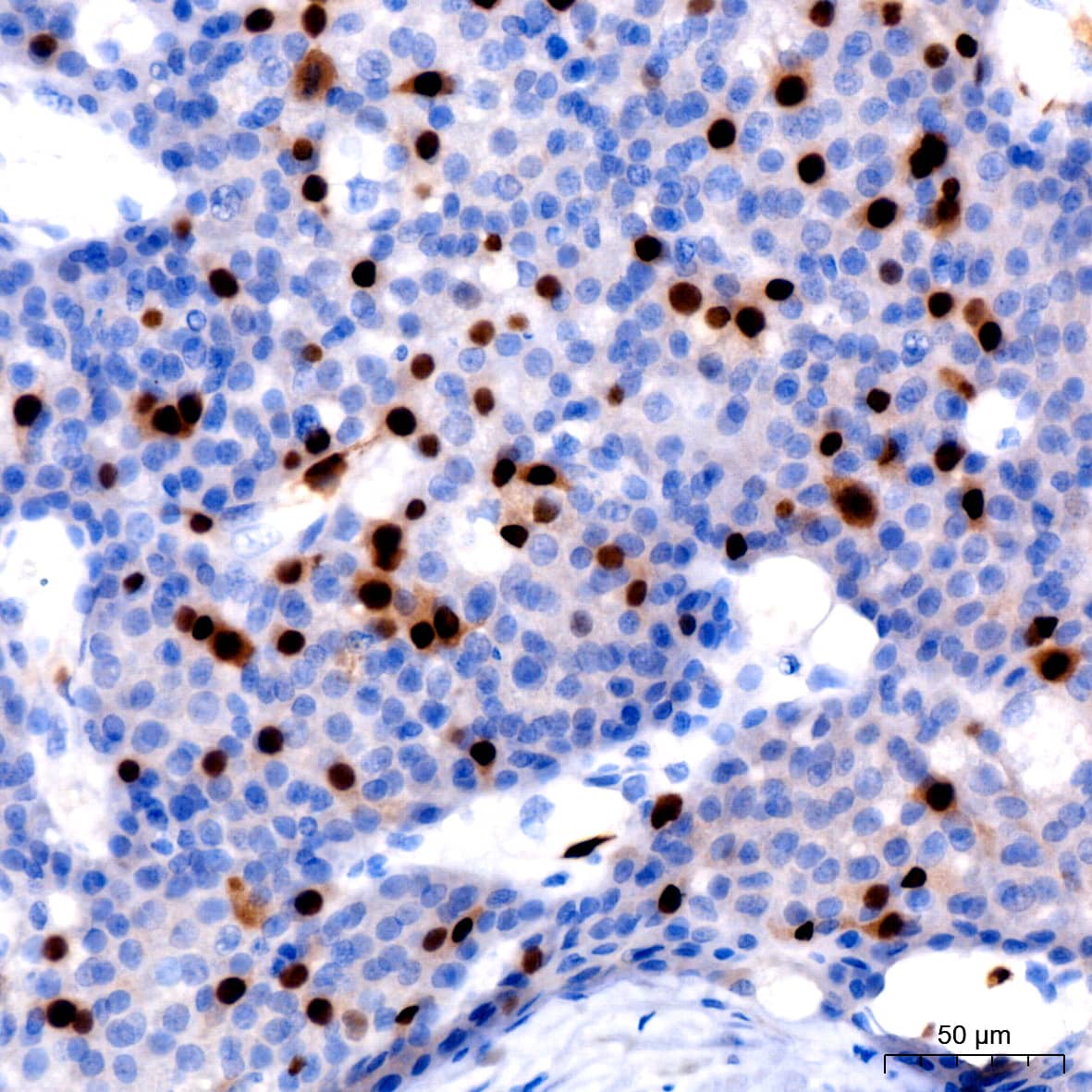 Immunohistochemistry: Cyclin A2 Antibody (3E9Z3) [Cyclin A2] - Immunohistochemistry analysis of paraffin-embedded Human liver cancer using Cyclin A2 Rabbit mAb  at dilution of 1:200 (40x lens). High pressure antigen retrieval performed with 0.01M Citrate Bufferr (pH 6.0) prior to IHC staining.