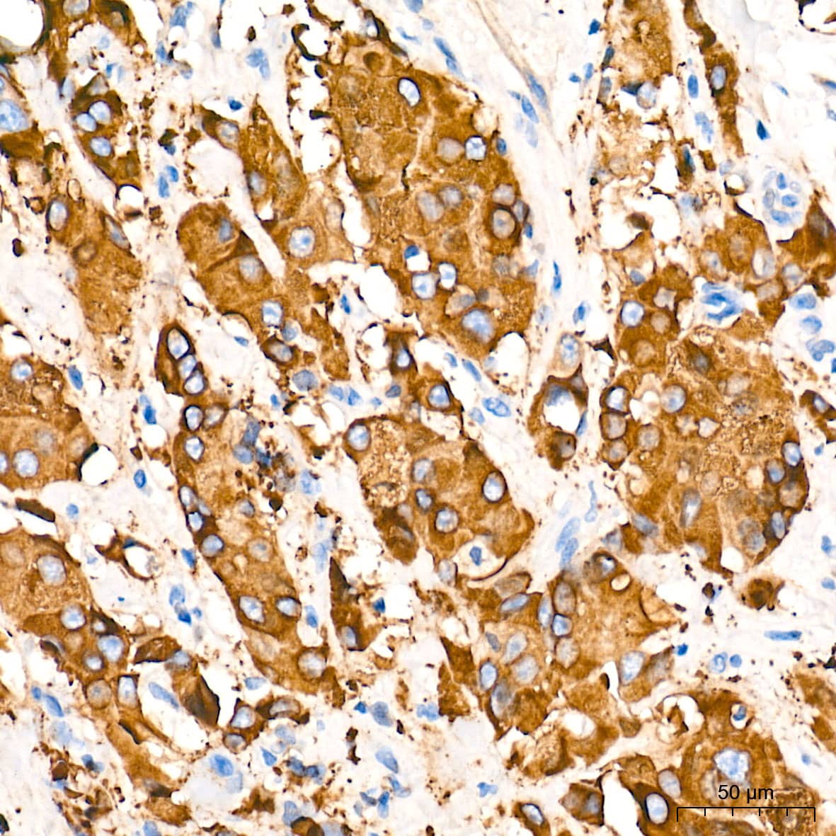 Immunohistochemistry: Fatty Acid Synthase/FASN Antibody (4U9S3) [Fatty Acid Synthase/FASN] - Immunohistochemistry analysis of paraffin-embedded Human breast cancer tissue using Fatty Acid Synthase/FASN Rabbit mAb  at a dilution of 1:2000 (40x lens). High pressure antigen retrieval performed with 0.01M Tris-EDTA Buffer (pH 9.0) prior to IHC staining.