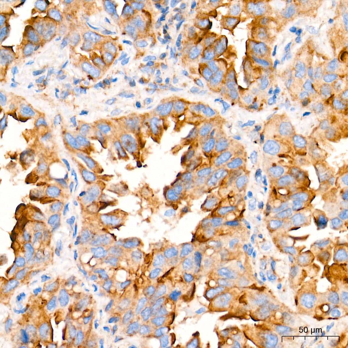 Immunohistochemistry: Fatty Acid Synthase/FASN Antibody (4U9S3) [Fatty Acid Synthase/FASN] - Immunohistochemistry analysis of paraffin-embedded Human lung cancer tissue using Fatty Acid Synthase/FASN Rabbit mAb  at a dilution of 1:2000 (40x lens). High pressure antigen retrieval performed with 0.01M Tris-EDTA Buffer (pH 9.0) prior to IHC staining.