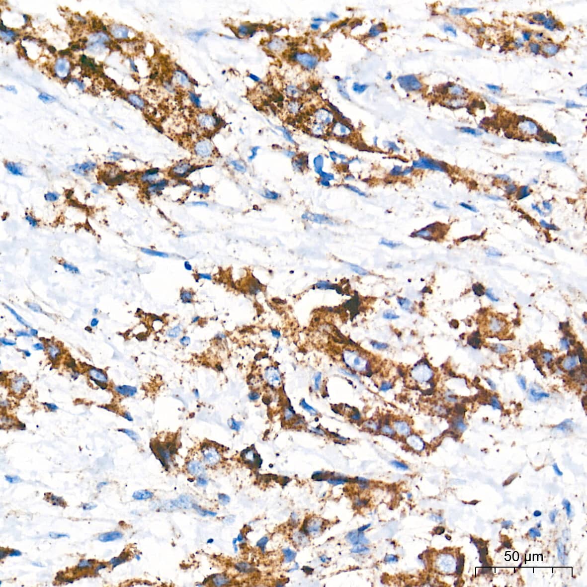 Immunohistochemistry: Glucosylceramidase/GBA Antibody (8O3Z7) [Glucosylceramidase/GBA] - Immunohistochemistry analysis of paraffin-embedded Human breast cancer tissue using Glucosylceramidase/GBA Rabbit mAb  at a dilution of 1:400 (40x lens). High pressure antigen retrieval performed with 0.01M Tris-EDTA Buffer (pH 9.0) prior to IHC staining.