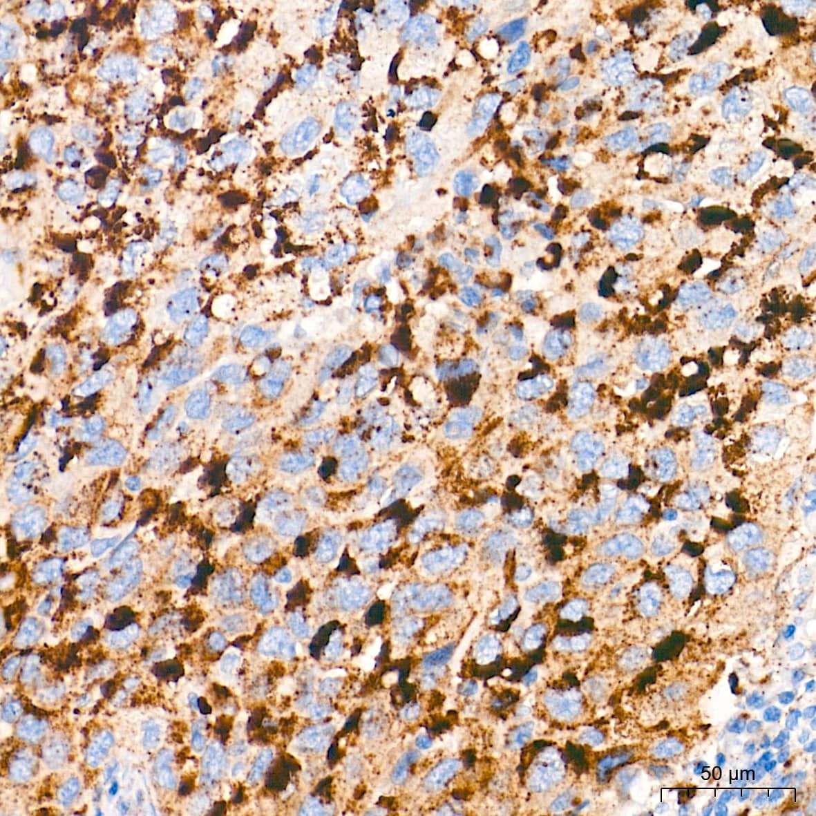 Immunohistochemistry: Glucosylceramidase/GBA Antibody (8O3Z7) [Glucosylceramidase/GBA] - Immunohistochemistry analysis of paraffin-embedded Human lung squamous carcinoma tissue using Glucosylceramidase/GBA Rabbit mAb  at a dilution of 1:400 (40x lens). High pressure antigen retrieval performed with 0.01M Tris-EDTA Buffer (pH 9.0) prior to IHC staining.