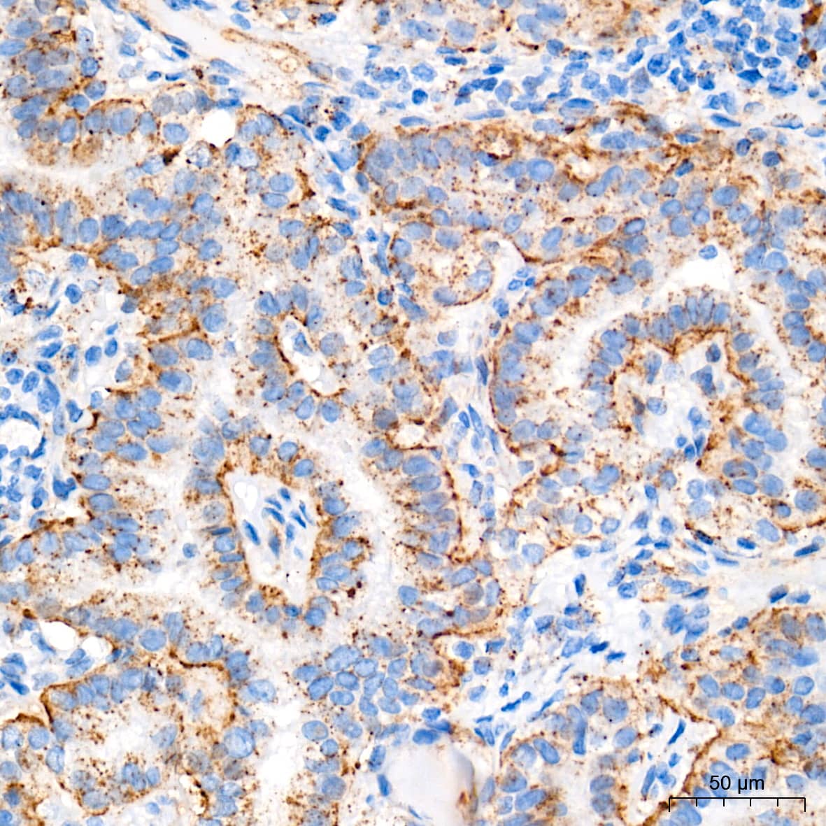 Immunohistochemistry: Glucosylceramidase/GBA Antibody (8O3Z7) [Glucosylceramidase/GBA] - Immunohistochemistry analysis of paraffin-embedded Human thyroid cancer tissue using Glucosylceramidase/GBA Rabbit mAb  at a dilution of 1:400 (40x lens). High pressure antigen retrieval performed with 0.01M Tris-EDTA Buffer (pH 9.0) prior to IHC staining.