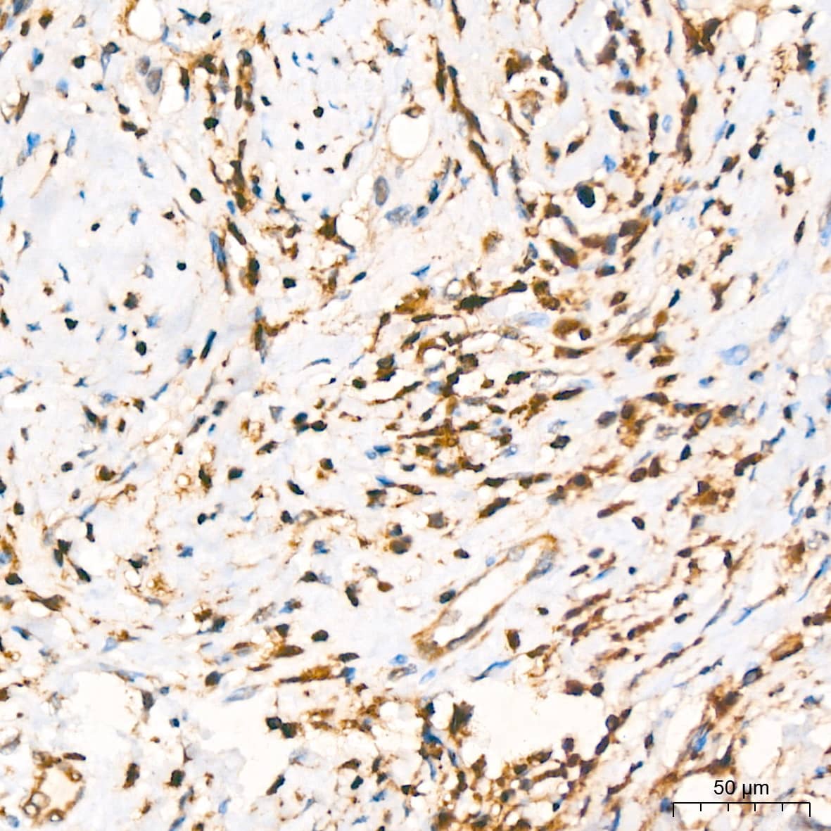 Immunohistochemistry: GRB2 Antibody (9K6H0) [GRB2] - Immunohistochemistry analysis of paraffin-embedded Human breast cancer using GRB2 Rabbit mAb  at dilution of 1:200 (40x lens). High pressure antigen retrieval performed with 0.01M Citrate Bufferr (pH 6.0) prior to IHC staining.