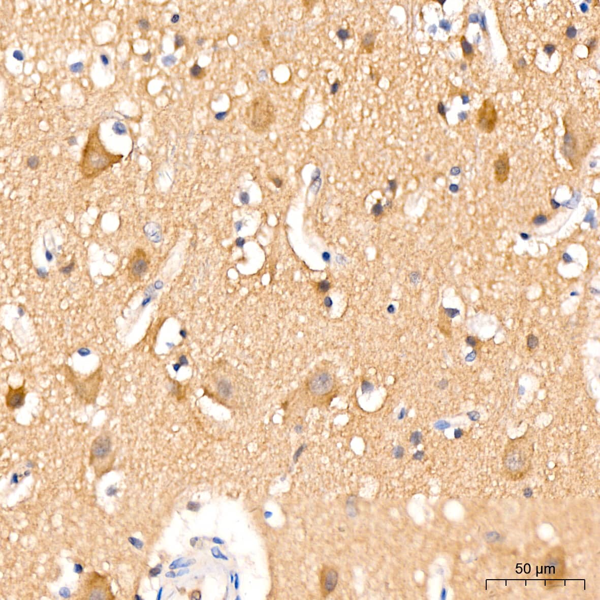 Immunohistochemistry: Huntingtin Antibody (7B9C8) [Huntingtin] - Immunohistochemistry analysis of paraffin-embedded Human brain tissue using Huntingtin Rabbit mAb  at a dilution of 1:200 (40x lens). High pressure antigen retrieval was performed with 0.01 M citrate buffer (pH 6.0) prior to IHC staining.