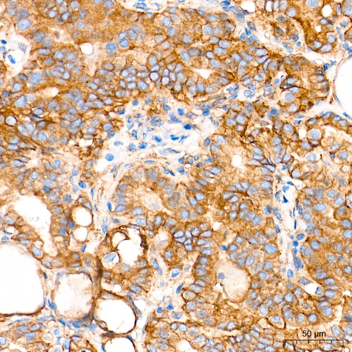 Immunohistochemistry: Integrin alpha V/CD51 Antibody (10T9N2) [Integrin alpha V/CD51] - Immunohistochemistry analysis of paraffin-embedded Human thyroid cancer tissue using Integrin alpha V/CD51 Rabbit mAb  at a dilution of 1:2000 (40x lens). High pressure antigen retrieval performed with 0.01M Tris-EDTA Buffer (pH 9.0) prior to IHC staining.