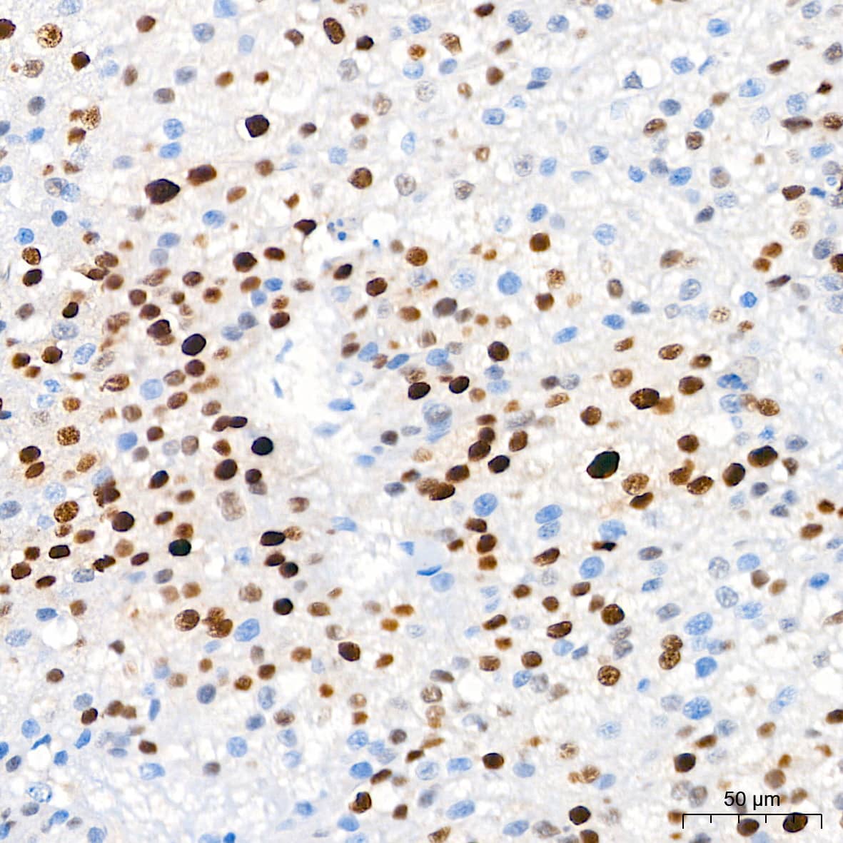 Immunohistochemistry: p21/CIP1/CDKN1A Antibody (4Z1H9) [p21/CIP1/CDKN1A] - Immunohistochemistry analysis of paraffin-embedded Human liver cancer tissue using [KO Validated] p21/CIP1/CDKN1A Rabbit mAb  at a dilution of 1:200 (40x lens). High pressure antigen retrieval performed with 0.01M Tris-EDTA Buffer(pH 9.0) prior to IHC staining.