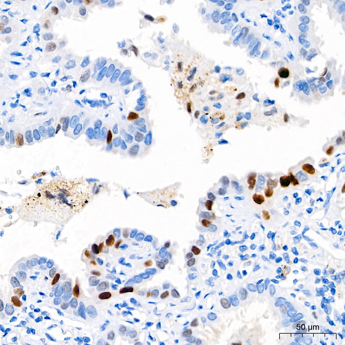 Immunohistochemistry: p21/CIP1/CDKN1A Antibody (4Z1H9) [p21/CIP1/CDKN1A] - Immunohistochemistry analysis of paraffin-embedded Human lung adenocarcinoma tissue using [KO Validated] p21/CIP1/CDKN1A Rabbit mAb  at a dilution of 1:200 (40x lens). High pressure antigen retrieval performed with 0.01M Tris-EDTA Buffer(pH 9.0) prior to IHC staining.