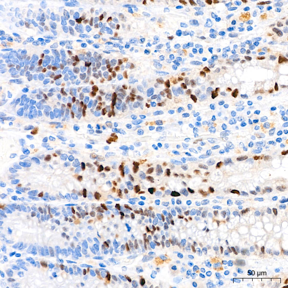 Immunohistochemistry: p21/CIP1/CDKN1A Antibody (4Z1H9) [p21/CIP1/CDKN1A] - Immunohistochemistry analysis of paraffin-embedded Human colon tissue using [KO Validated] p21/CIP1/CDKN1A Rabbit mAb  at a dilution of 1:200 (40x lens). High pressure antigen retrieval performed with 0.01M Tris-EDTA Buffer(pH 9.0) prior to IHC staining.