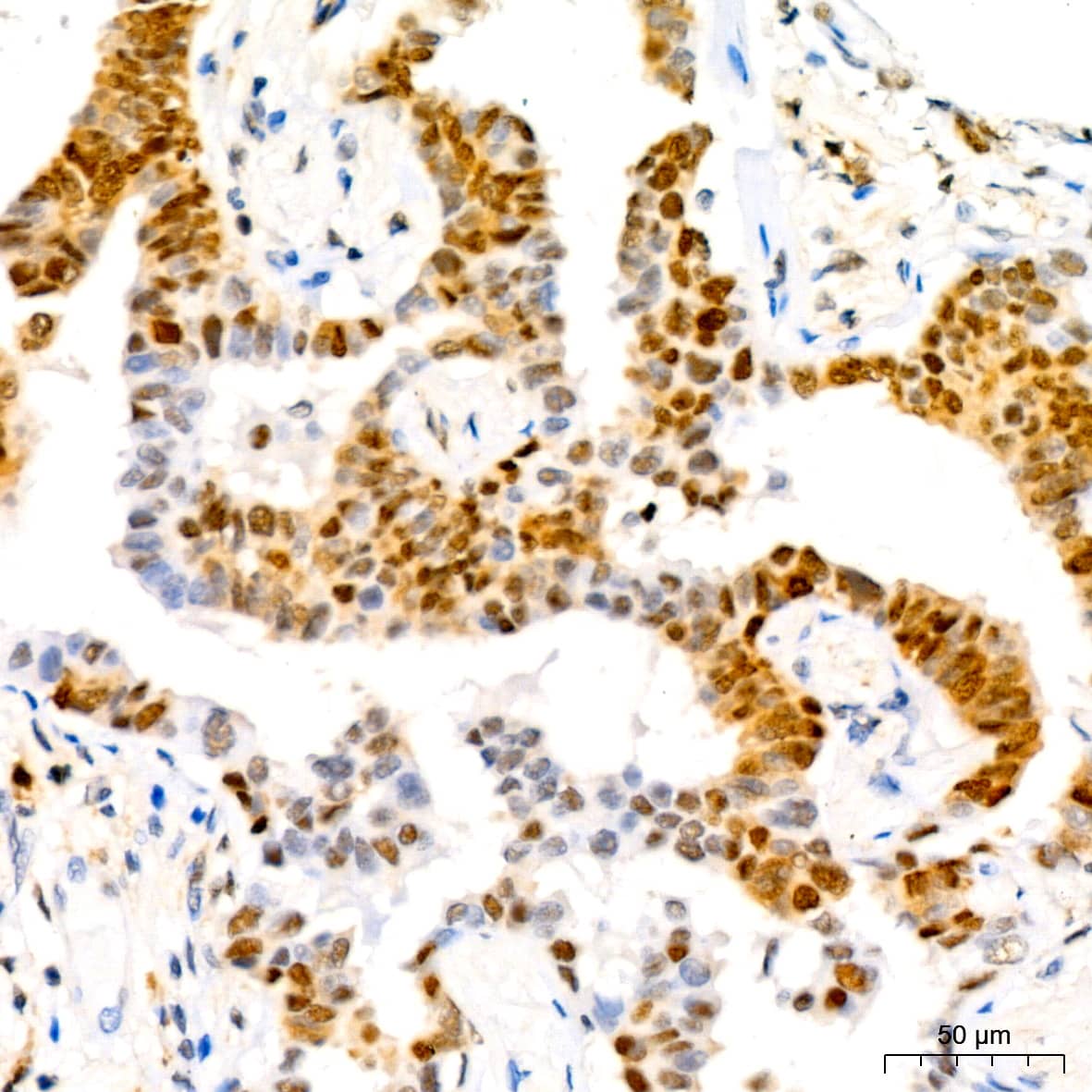 Immunohistochemistry: p27/Kip1 Antibody (9R5B4) [p27/Kip1] - Immunohistochemistry analysis of paraffin-embedded Human lung adenocarcinoma tissue using p27/Kip1 Rabbit mAb  at a dilution of 1:200 (40x lens). High pressure antigen retrieval performed with 0.01M Citrate Buffer (pH 6.0) prior to IHC staining.