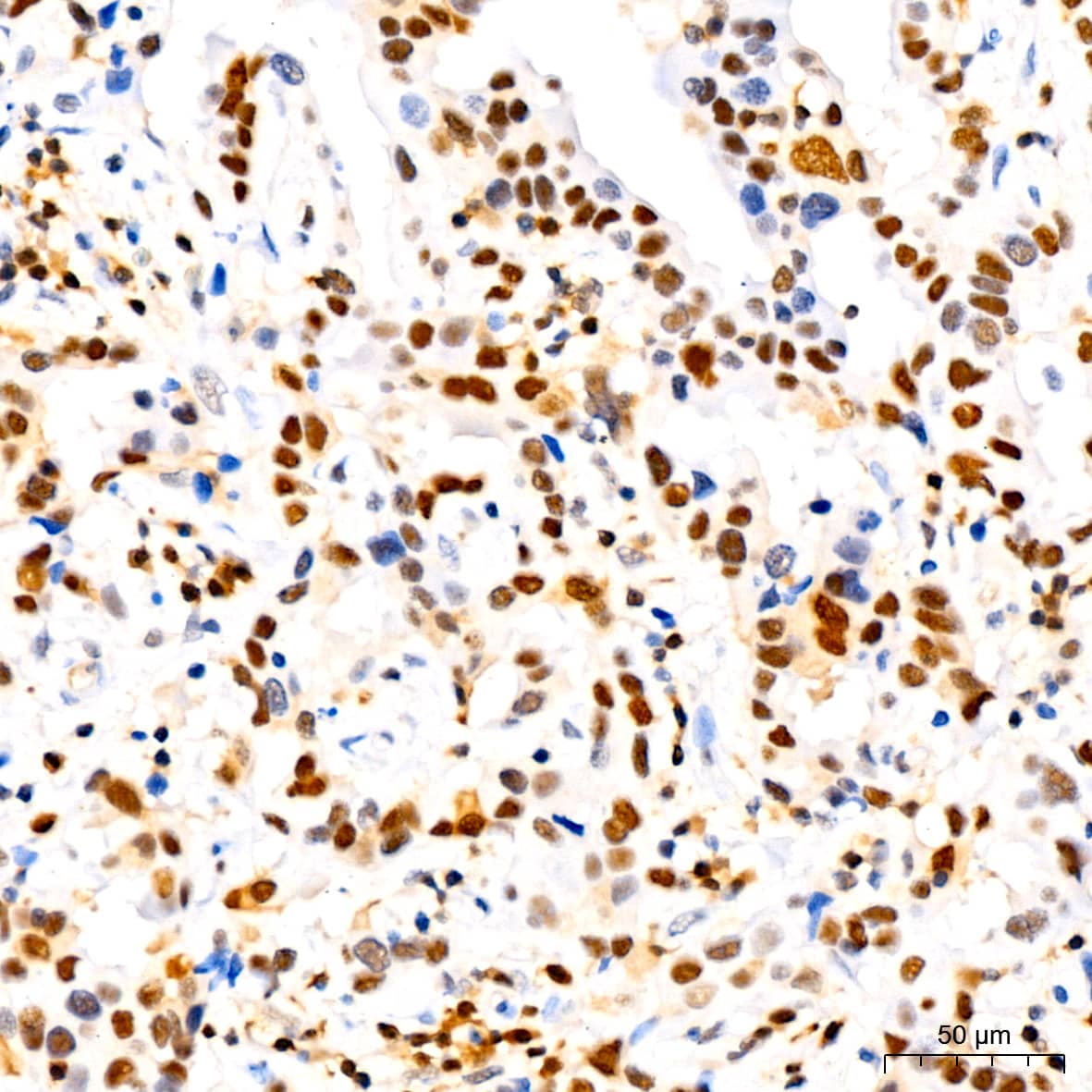 Immunohistochemistry: p27/Kip1 Antibody (9R5B4) [p27/Kip1] - Immunohistochemistry analysis of paraffin-embedded Human breast cancer tissue using p27/Kip1 Rabbit mAb  at a dilution of 1:200 (40x lens). High pressure antigen retrieval performed with 0.01M Citrate Buffer (pH 6.0) prior to IHC staining.