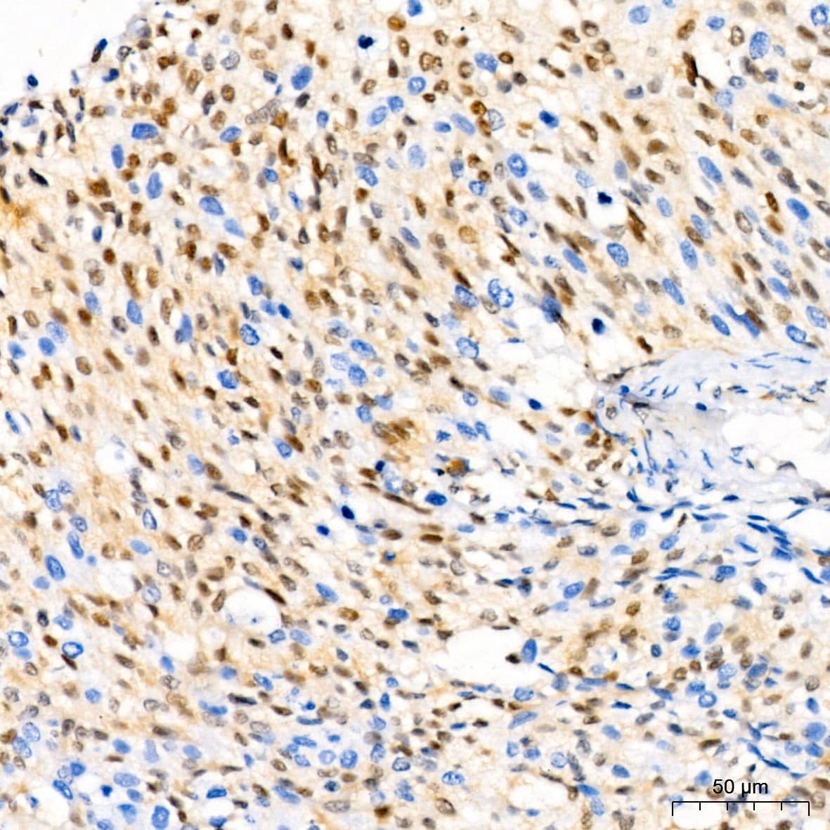 Immunohistochemistry: p27/Kip1 Antibody (9R5B4) [p27/Kip1] - Immunohistochemistry analysis of paraffin-embedded Human lung squamous carcinoma tissue using p27/Kip1 Rabbit mAb  at a dilution of 1:200 (40x lens). High pressure antigen retrieval performed with 0.01M Citrate Buffer (pH 6.0) prior to IHC staining.