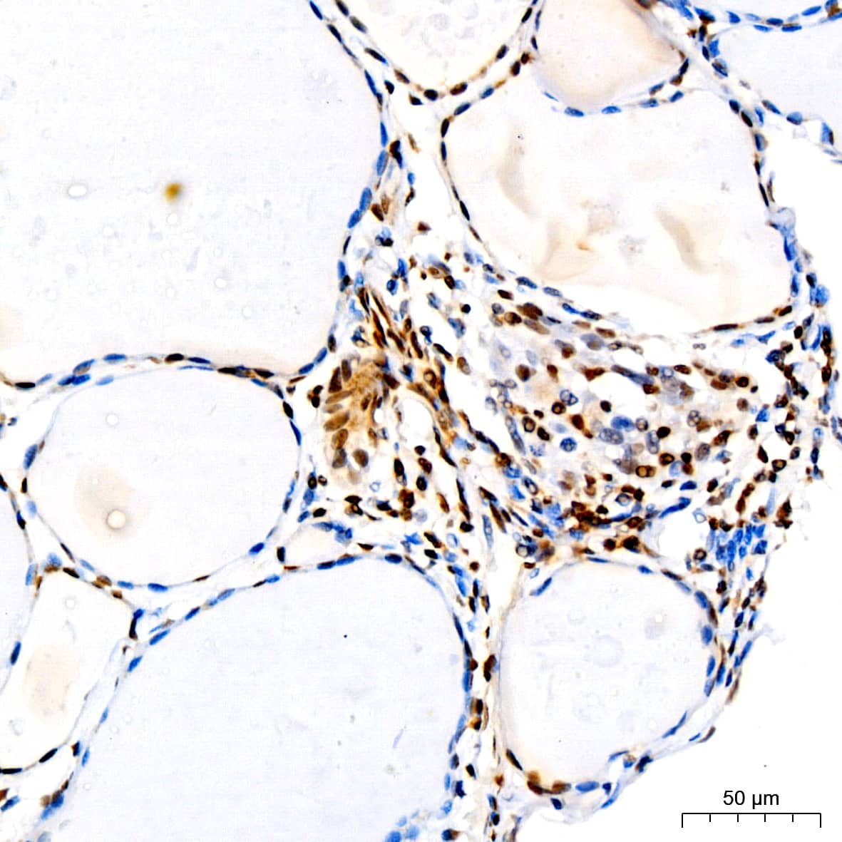 Immunohistochemistry: p27/Kip1 Antibody (9R5B4) [p27/Kip1] - Immunohistochemistry analysis of paraffin-embedded Human thyroid tissue using p27/Kip1 Rabbit mAb  at a dilution of 1:200 (40x lens). High pressure antigen retrieval performed with 0.01M Citrate Buffer (pH 6.0) prior to IHC staining.