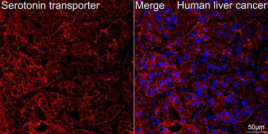 Immunocytochemistry/ Immunofluorescence: SLC6A4/5-HTTLPR/Serotonin transporter Antibody (5T7M2) [SLC6A4/5-HTTLPR/Serotonin transporter] - Confocal imaging of paraffin-embedded Human liver cancer tissue using SLC6A4/5-HTTLPR/Serotonin transporter Rabbit mAb  followed by a further incubation with Cy3 Goat Anti-Rabbit IgG (H+L)  . DAPI was used for nuclear staining (Blue). Objective: 40x. Perform high pressure antigen retrieval with 0.01 M citrate buffer (pH 6.0) prior to IF staining.