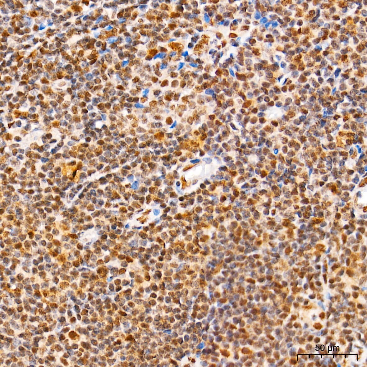 Immunohistochemistry: SUMO1 Antibody (6F8B6) [SUMO1] - Immunohistochemistry analysis of paraffin-embedded Human tonsil tissue using [KO Validated] SUMO1 Rabbit mAb  at a dilution of 1:5000 (40x lens). High pressure antigen retrieval performed with 0.01M Tris-EDTA Buffer (pH 9.0) prior to IHC staining.