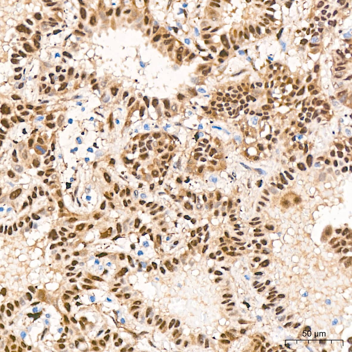 Immunohistochemistry: YAP1 Antibody (10G4S10) [YAP1] - Immunohistochemistry analysis of paraffin-embedded Human lung adenocarcinoma tissue using [KO Validated] YAP1 Rabbit mAb  at a dilution of 1:400 (40x lens). High pressure antigen retrieval performed with 0.01M Citrate Bufferr (pH 6.0) prior to IHC staining.