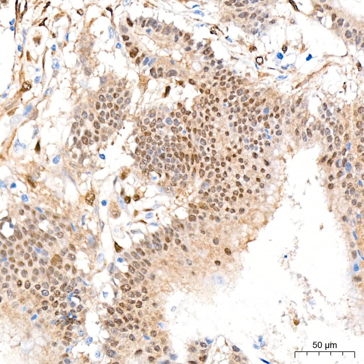 Immunohistochemistry: YAP1 Antibody (10G4S10) [NBP3-15685] - Immunohistochemistry analysis of paraffin-embedded Human colon carcinoma tissue using [KO Validated] YAP1 Rabbit mAb  at a dilution of 1:400 (40x lens). High pressure antigen retrieval performed with 0.01M Citrate Bufferr (pH 6.0) prior to IHC staining.