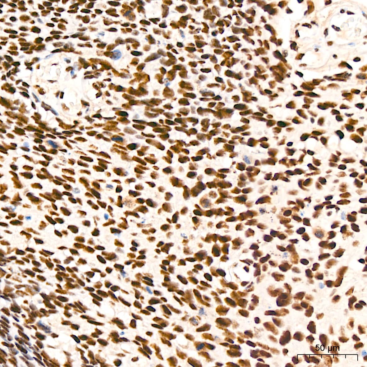 Immunohistochemistry: XPD Antibody (6T9K6) [NBP3-15704] - Immunohistochemistry analysis of XPD in paraffin-embedded human cervix cancer tissue using XPD Rabbit mAb  at a dilution of 1:200 (40x lens). High pressure antigen retrieval was performed with 0.01 M Tris-EDTA buffer (pH 9.0) prior to IHC staining.