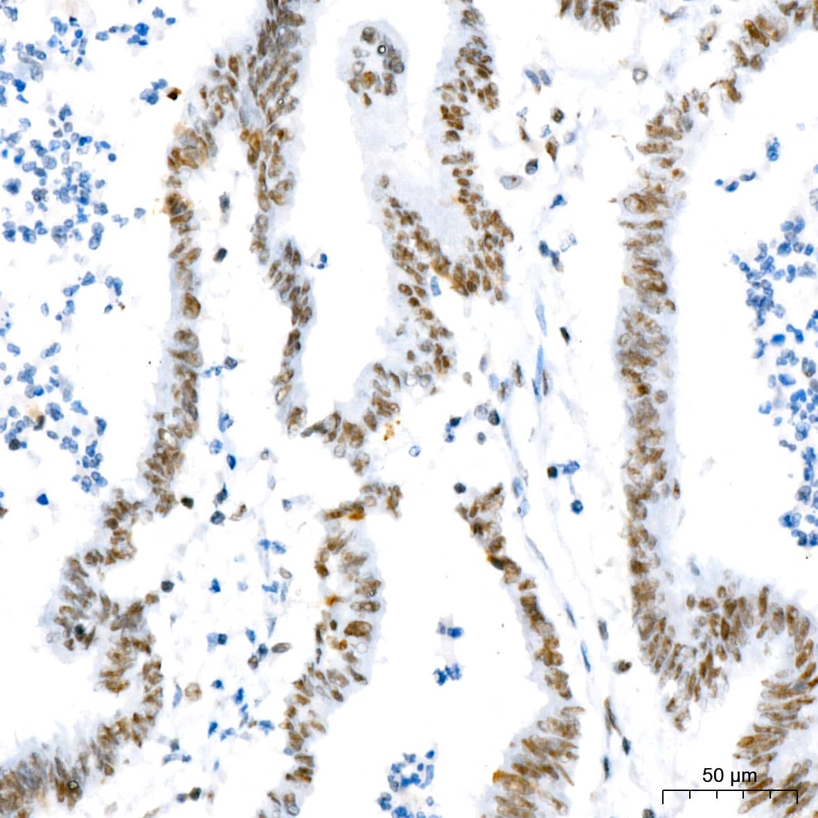 Immunohistochemistry: NAT10 Antibody (5Z3E5) [NAT10] - Immunohistochemistry analysis of paraffin-embedded Human colon carcinoma using NAT10 Rabbit mAb  at dilution of 1:200 (40x lens). High pressure antigen retrieval performed with 0.01M Tris/EDTA Buffer (pH 9.0) prior to IHC staining.