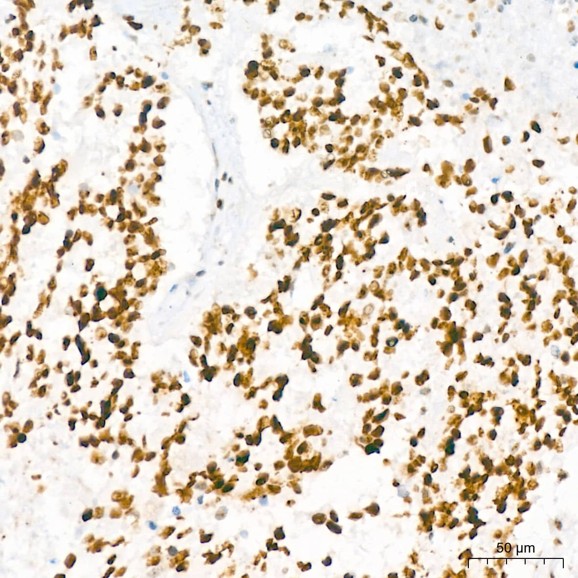 Immunohistochemistry: NAT10 Antibody (5Z3E5) [NAT10] - Immunohistochemistry analysis of paraffin-embedded Human lung squamous carcinoma tissue using NAT10 Rabbit mAb  at dilution of 1:200 (40x lens). High pressure antigen retrieval performed with 0.01M Tris/EDTA Buffer (pH 9.0) prior to IHC staining.