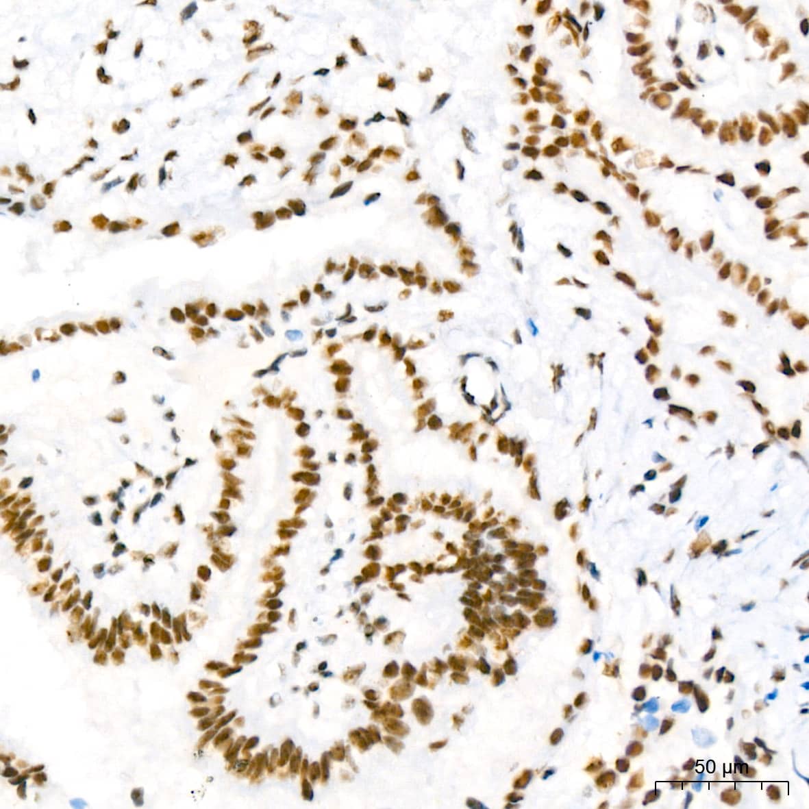 Immunohistochemistry: NAT10 Antibody (5Z3E5) [NAT10] - Immunohistochemistry analysis of paraffin-embedded Human thyroid cancer using NAT10 Rabbit mAb  at dilution of 1:200 (40x lens). High pressure antigen retrieval performed with 0.01M Tris/EDTA Buffer (pH 9.0) prior to IHC staining.