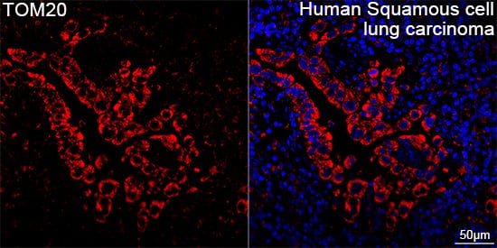 Immunocytochemistry/ Immunofluorescence: TOMM20 Antibody (10G6I8) [TOMM20] - Confocal imaging of paraffin-embedded Human squamous cell lung carcinoma tissue using TOMM20 Rabbit mAb  followed by a further incubation with Cy3 Goat Anti-Rabbit IgG (H+L)  . DAPI was used for nuclear staining (Blue). High pressure antigen retrieval performed with 0.01M Citrate Buffer (pH 6.0) prior to IF staining. Objective: 40x.