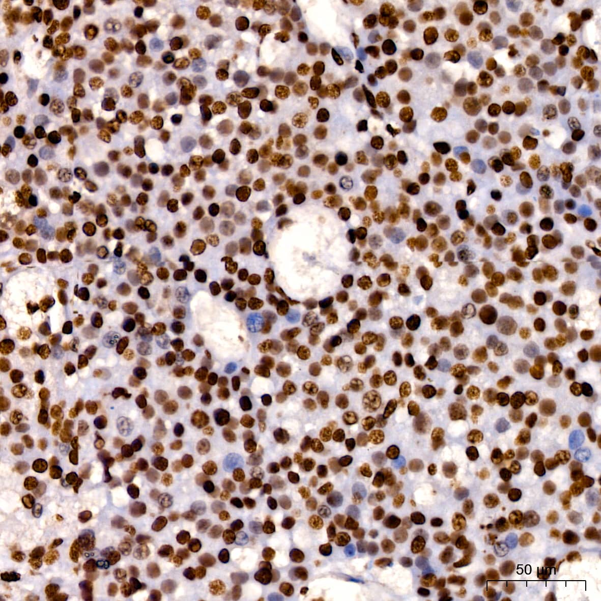 Immunohistochemistry: HMGB1/HMG-1 Antibody (1C4T5) [HMGB1/HMG-1] - Immunohistochemistry analysis of paraffin-embedded Human liver cancer using [KO Validated] HMGB1/HMG-1 Rabbit mAb  at dilution of 1:200 (40x lens). High pressure antigen retrieval performed with 0.01M Citrate Bufferr (pH 6.0) prior to IHC staining.