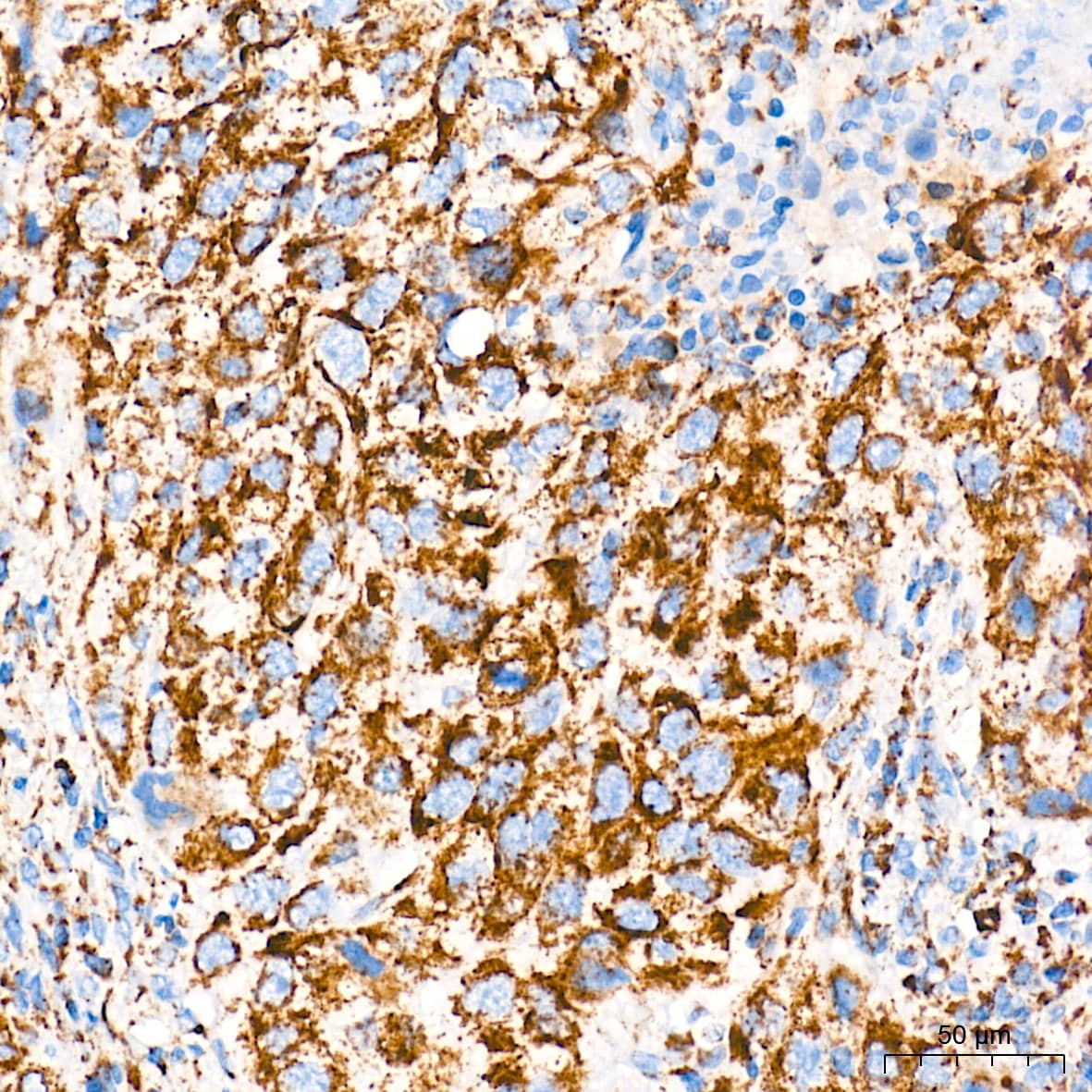 Immunohistochemistry: AIF Antibody (5F0Y1) [AIF] - Immunohistochemistry analysis of paraffin-embedded Human lung squamous carcinoma tissue using AIF Rabbit mAb  at a dilution of 1:500 (40x lens). High pressure antigen retrieval performed with 0.01M Tris-EDTA Buffer (pH 9.0) prior to IHC staining.